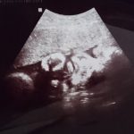【33週・34週】妊娠後期で妊娠糖尿病発症。母体・胎児への影響は?