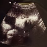【38週】無痛分娩（計画分娩）の予約！分娩誘発と促進とリスクについて