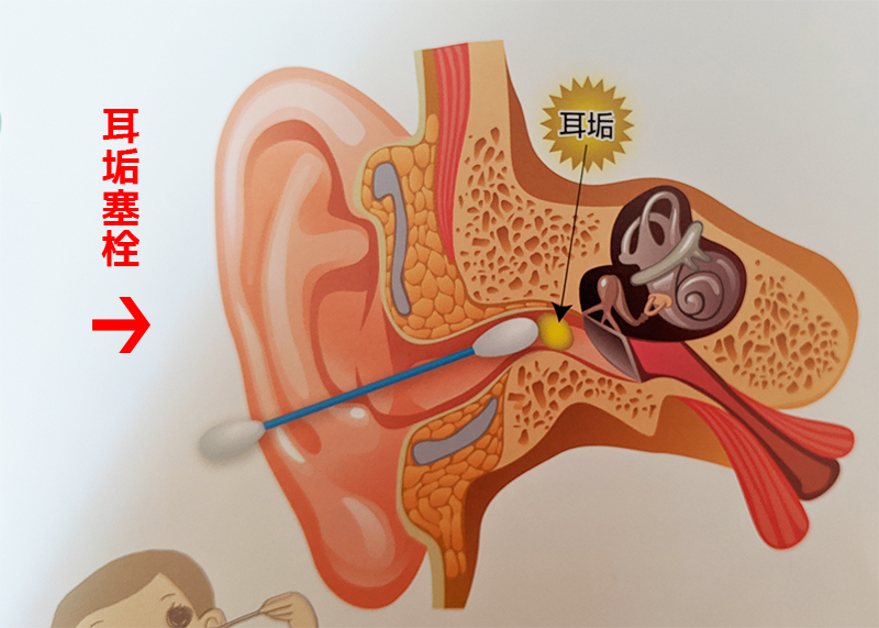 耳垢塞栓に注意！子どもの耳掃除の注意・頻度・やり方は？
