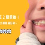 【体験談】ワイヤー矯正!子どもの歯列矯正2期にステップアップしました~費用・治療経過記録~